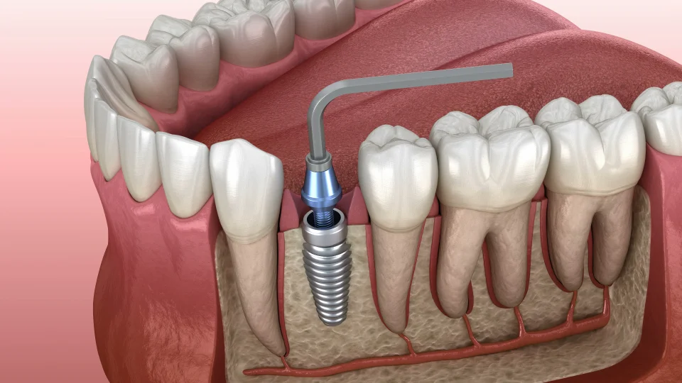 Overview of Implant Placement