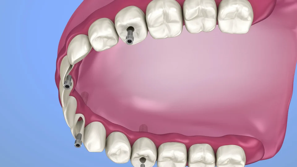 Teeth In An Hour ™