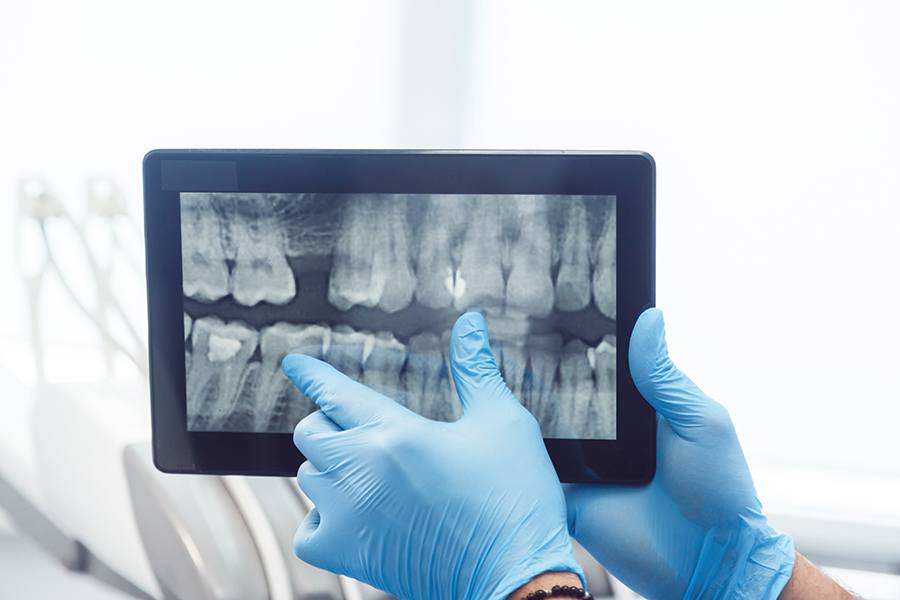 Benefits of Digital Dental X Rays