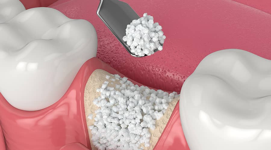Bone Grafting for Implants