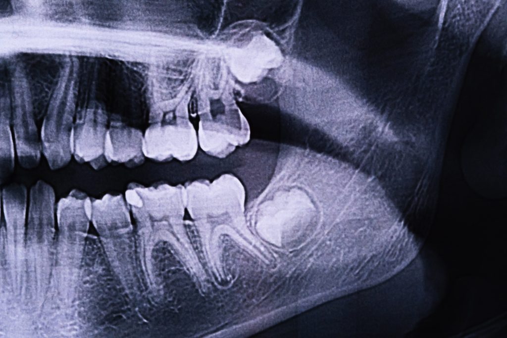 Panoramic X-ray