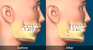 jaw surgery1