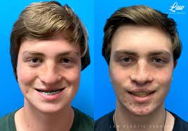 jaw surgery2