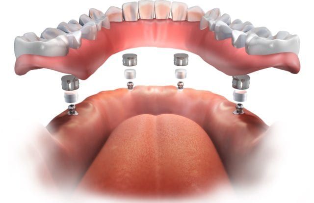 Implant Supported Overdenture