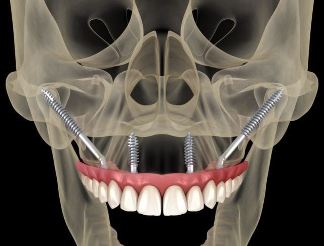 zygomatic dental implants