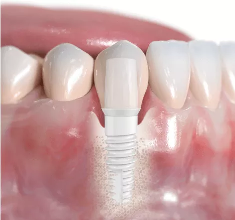 Ceramic Dental Implants