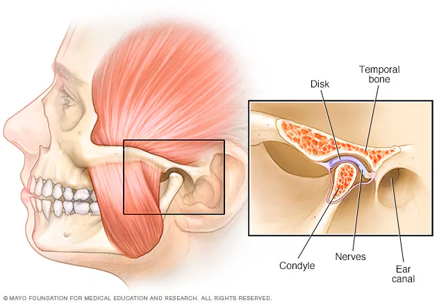 TMJ Disorders