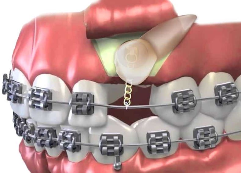 Exposure of Impacted Teeth