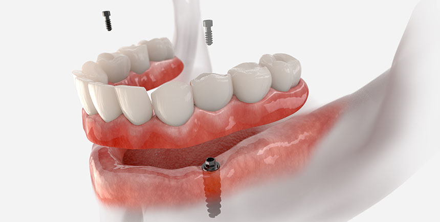 Pre-Prosthetic Surgery