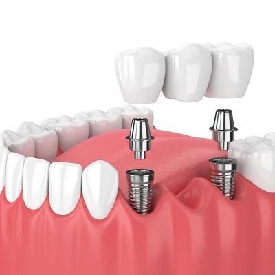 Cost of Dental Implants